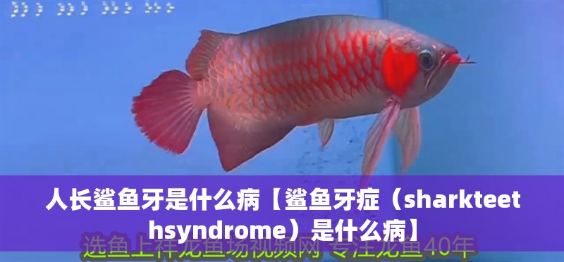 人長鯊魚牙是什么病【鯊魚牙癥（sharkteethsyndrome）是什么病】