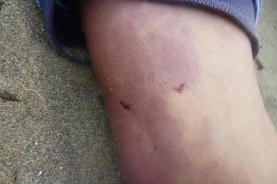 被魟魚刺到會怎么樣：被魟魚刺到可能會導致一系列嚴重的健康問題