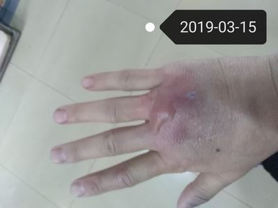 魟魚刺傷后的癥狀有哪些：魟魚刺傷后癥狀有哪些 魟魚刺傷后的癥狀有哪些：魟魚刺傷后癥狀有哪些 魟魚百科 第4張