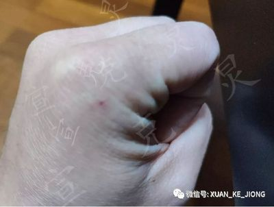 魟魚的毒刺扎手上怎么辦：魟魚的毒刺扎手可能會導致嚴重的健康問題因此需要采取適當的措施進行處理