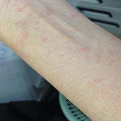 龍魚尾上長的痘痘是什么vs祥龍魚場：龍魚尾上長的痘痘是什么vs祥龍魚場的痘痘是什么