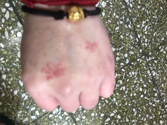非手術療法能治愈龍魚鰓蓋圓坑嗎?,手術治療龍魚鰓蓋圓坑存在風險,手術后多久能恢復 龍魚百科 第2張 非手術療法能治愈龍魚鰓蓋圓坑嗎?,手術治療龍魚鰓蓋圓坑存在風險,手術后多久能恢復 非手術療法能治愈龍魚鰓蓋圓坑嗎?,手術治療龍魚鰓蓋圓坑存在風險,手術后多久能恢復 龍魚百科 第2張