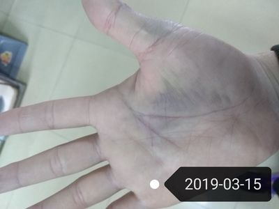 被魟魚刺到會有什么反應：被魟魚刺到會有怎樣的反應？