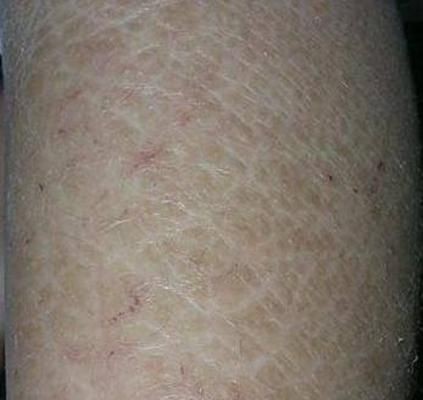 豎鱗病圖片，豎鱗病典型癥狀高清圖片