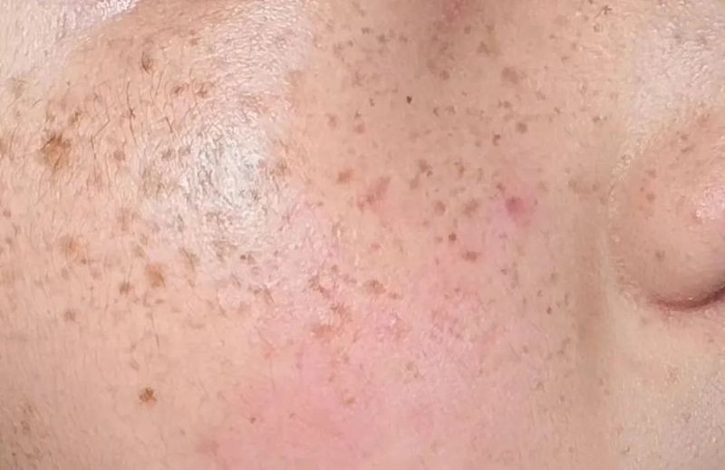 各種斑的區別圖解，常見色斑類型高清對比圖解