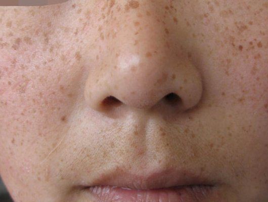 各種斑的區別圖解，常見色斑類型高清對比圖解