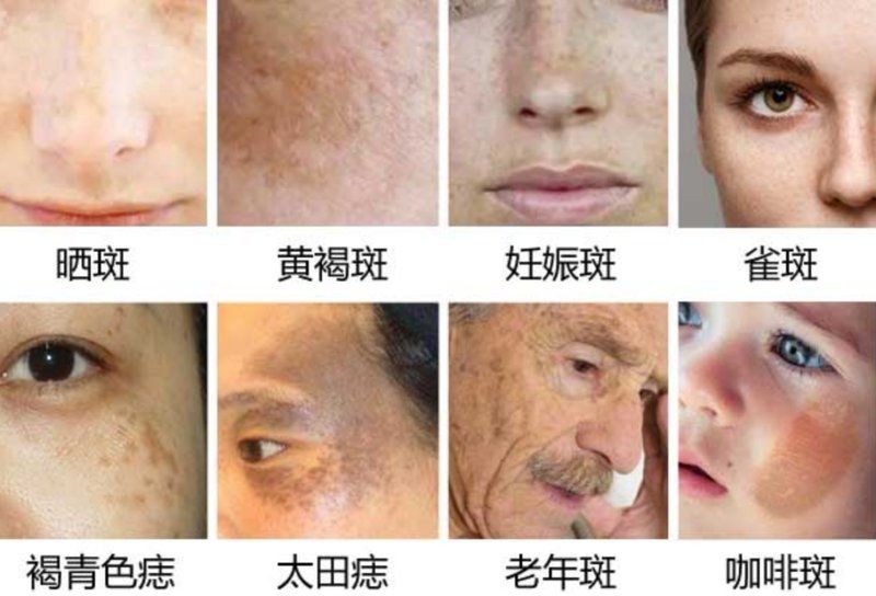 各種斑的區別圖解，常見色斑類型高清對比圖解