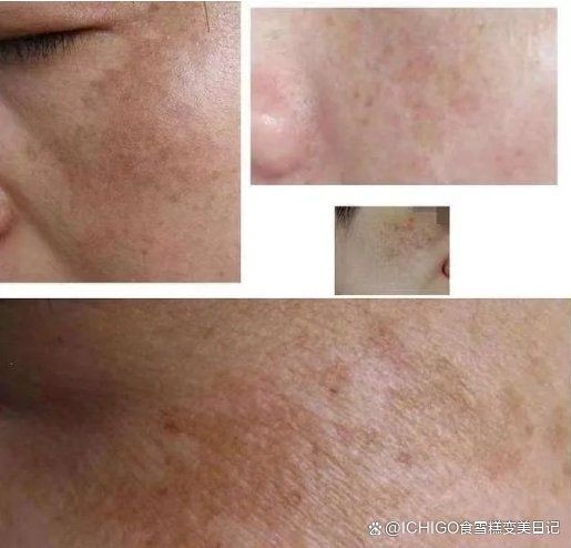 各種斑的區別圖解，常見色斑類型高清對比圖解