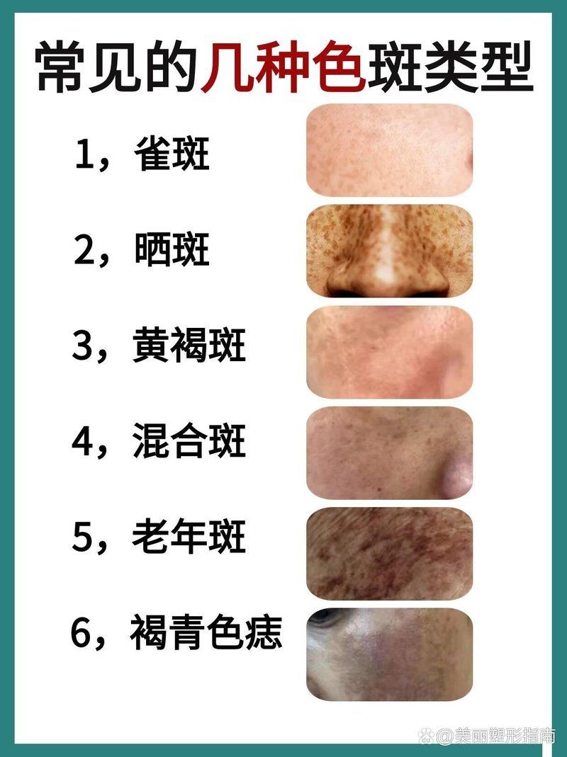 各種斑的區別圖解，常見色斑類型高清對比圖解