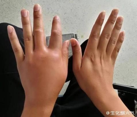 海洋弧菌感染早期圖片