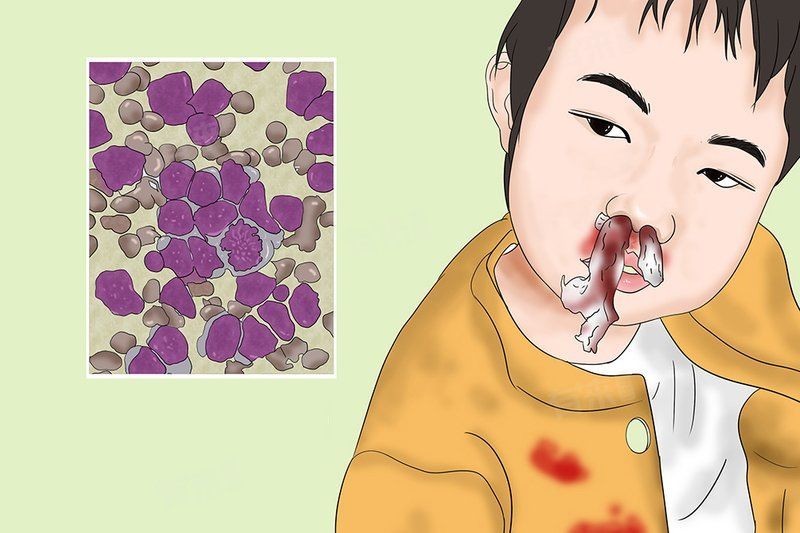 急性淋巴細(xì)胞白血病治愈率：兒童急性淋巴細(xì)胞白血病治愈率可達(dá)70%-80%-