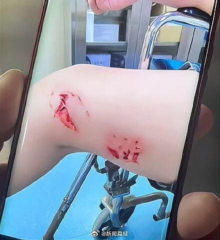 號半龍魚咬人后圖片：“號半龍魚咬人后”圖片引發關注