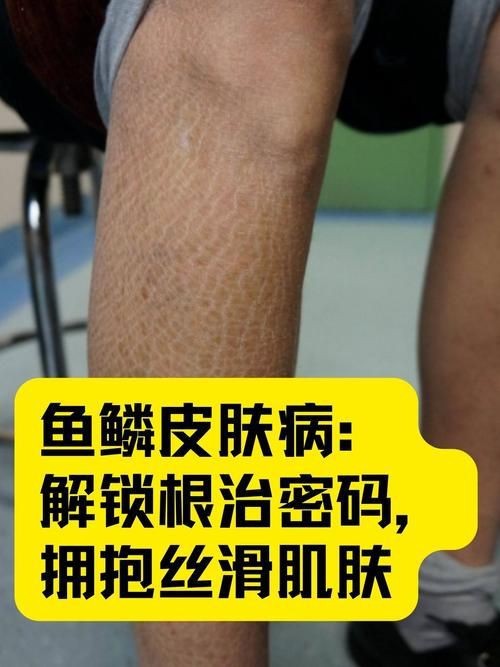 魚豎鱗病圖片，觀賞魚“炸鱗”是什么養魚人最頭疼的問題與解決辦法