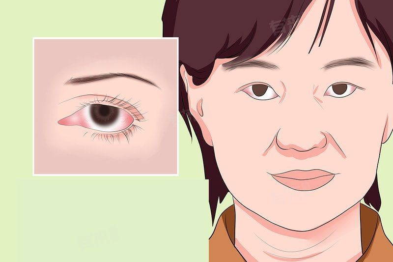 紅龍眼眼病最怕三個(gè)癥狀【民福康紅眼病的癥狀是什么】