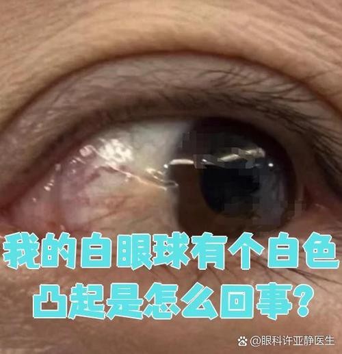 有沒有圖片展示龍眼白霧癥狀？