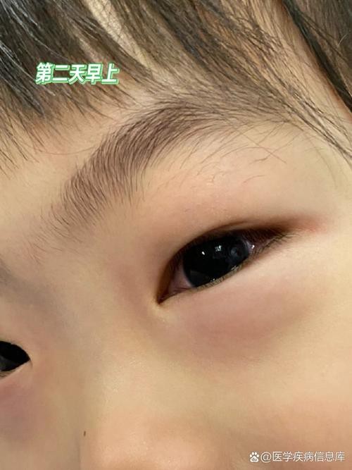 有沒有圖片展示龍眼白霧癥狀？