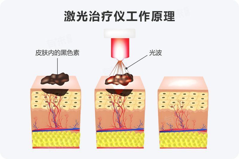 美人魚咬人后的疤痕怎么去除