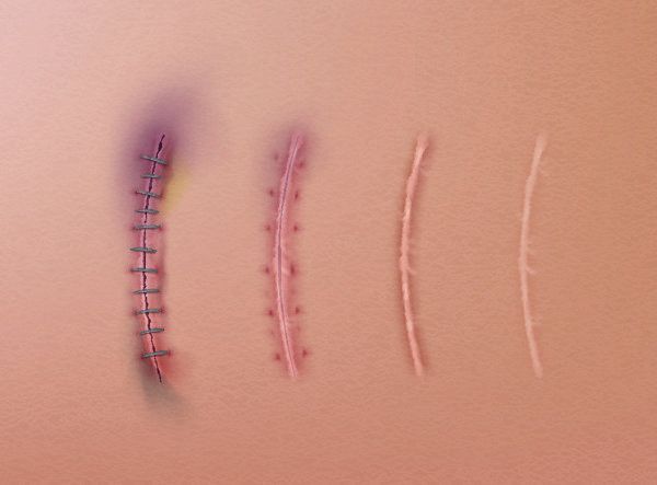 龍魚鰓蓋穿孔的康復時間一般是多久？