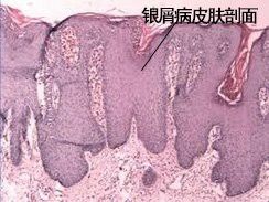 拔鱗手術的風險有多大？