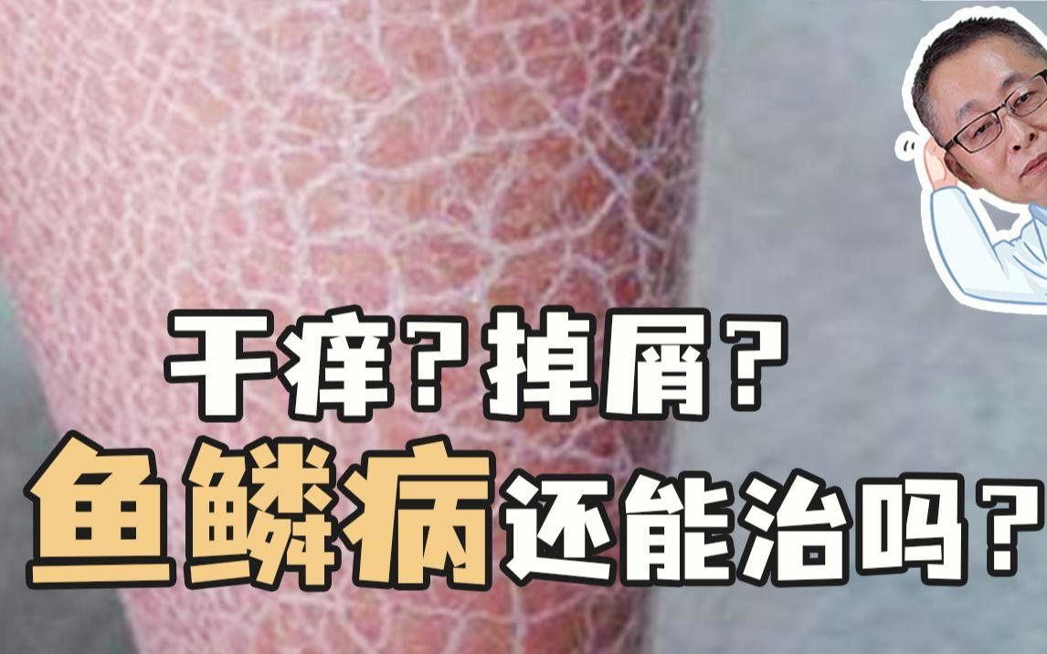 松鱗病一般多久能治愈？