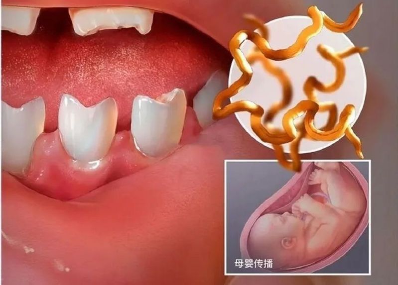 鋸齒牙和梅毒牙的區(qū)別