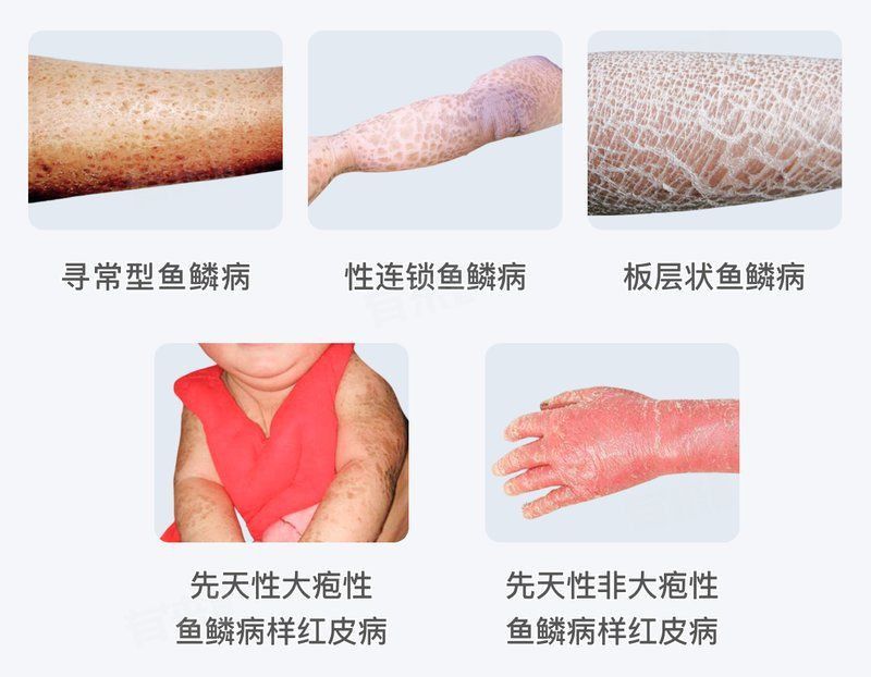 魚鱗病的癥狀有哪些？
