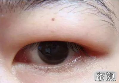 龍魚眼腫脹該怎么治療好：龍魚眼腫脹可能由多種原因引起，治療龍魚眼腫脹需綜合考慮多個因素