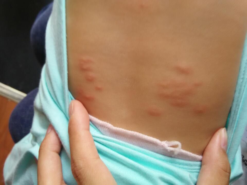 龍魚背部長疙瘩【龍魚背部長疙瘩可能由多種原因造成】