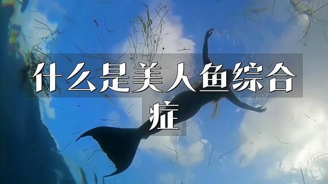 美人魚綜合癥是什么病