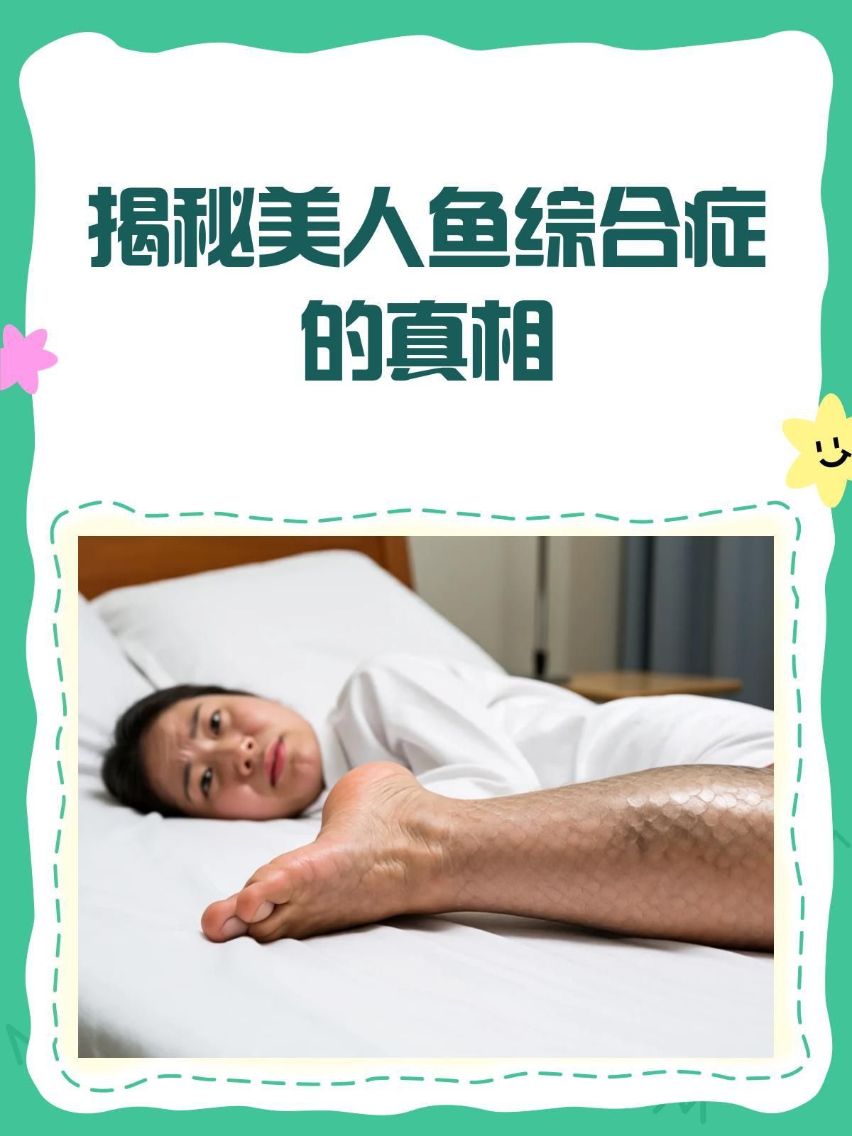 美人魚綜合癥是什么病