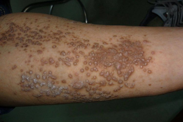 如何判斷松鱗病的嚴重程度？