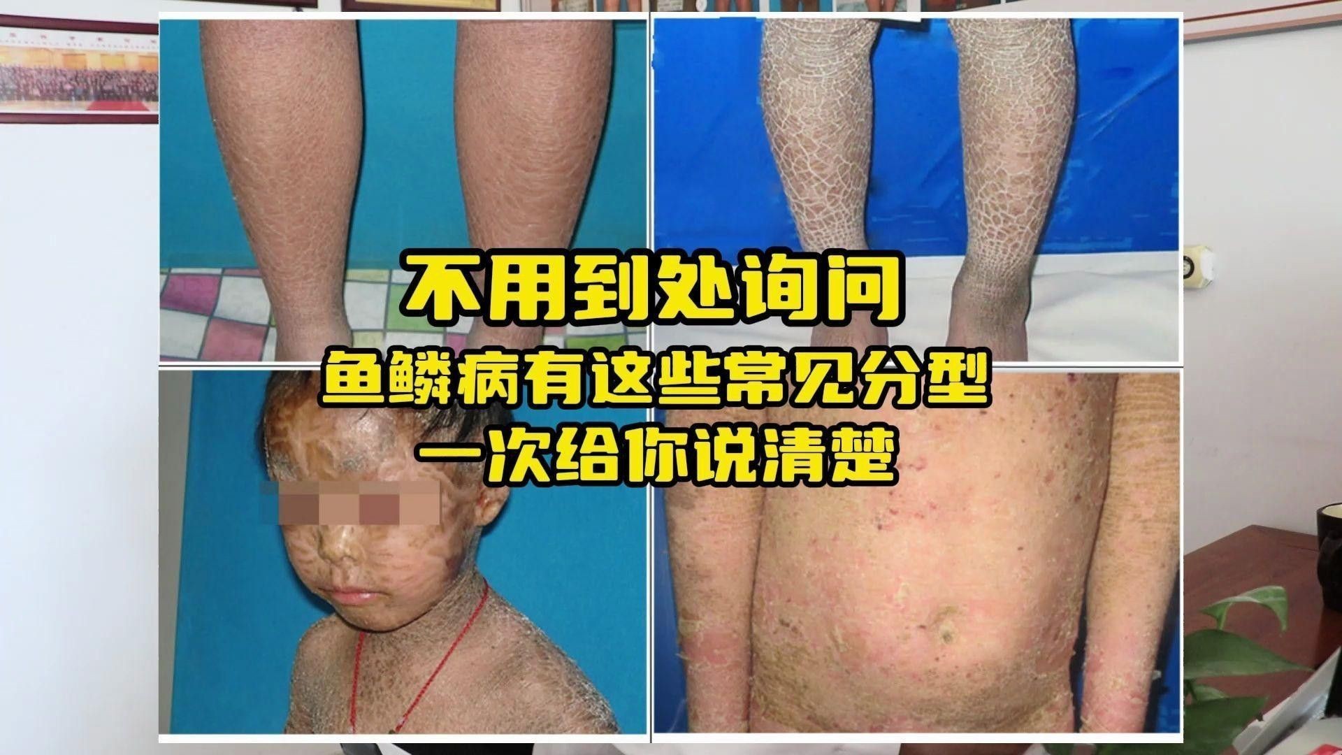 病態脫皮的癥狀有哪些？