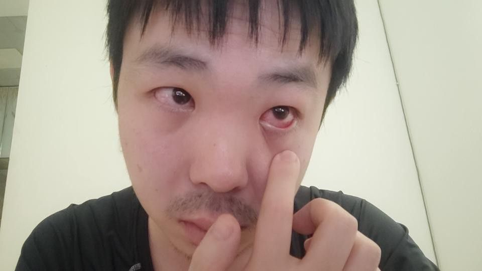 紅眼病多久會(huì)自愈？