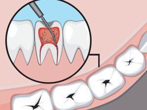 甲硝唑投入魚缸后多久見效？