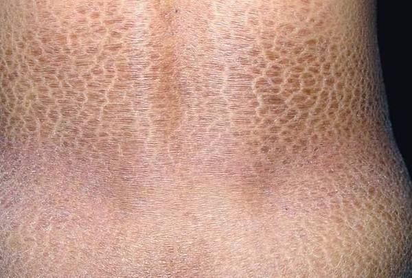 龍魚鱗病圖片對照