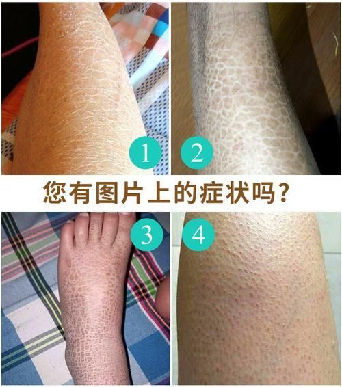 龍魚鱗病圖片對照