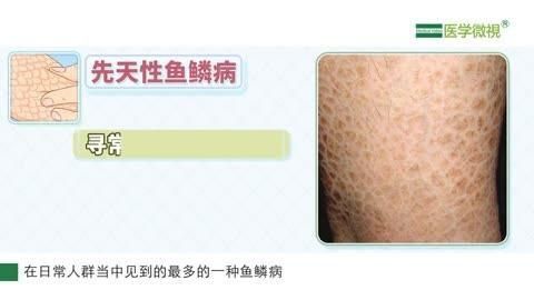 請(qǐng)?zhí)峁└嚓P(guān)于魚鱗病的信息