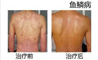 龍魚有一片鱗翹起來了是什么病：龍魚鱗片翹起可能是指它們患上了立鱗病，可能是患上了立鱗病