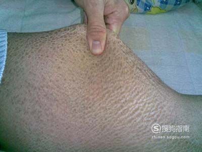 龍魚有一片鱗翹起來了是什么病：龍魚鱗片翹起可能是指它們患上了立鱗病，可能是患上了立鱗病
