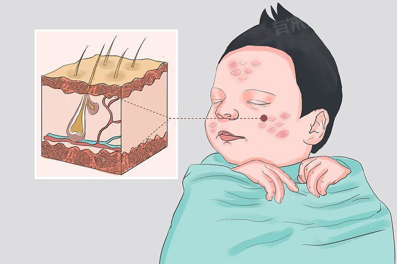 如何判斷自己是否患有魚鱗病？