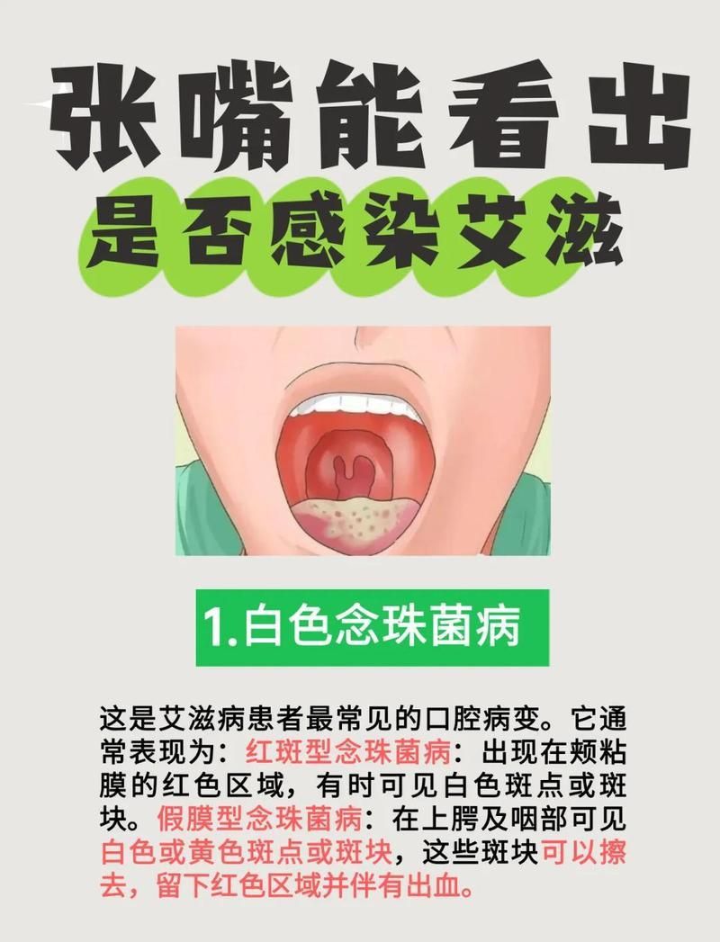龍魚細菌是艾滋病的早期癥狀嗎
