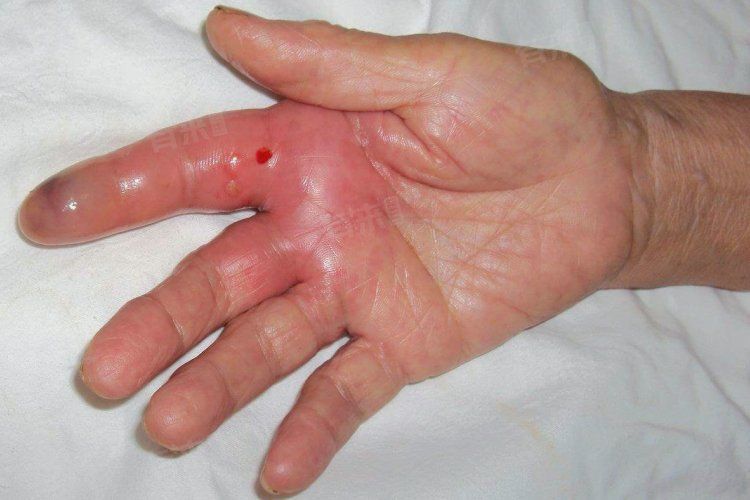 如何判斷自己是否感染了海水細菌？