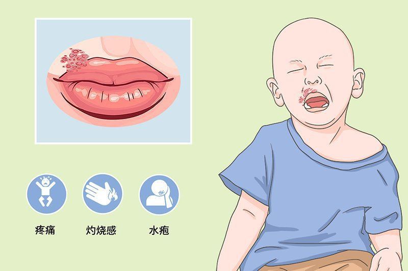 哪種類型的炸鱗病傳染性最強？