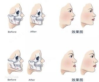 正頜手術風險大嗎？：正頜手術的風險與患者的具體病情、手術復雜性和醫療條件密切相關