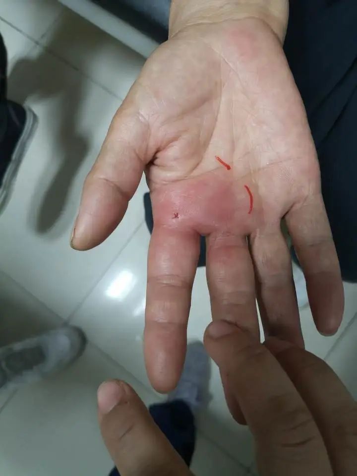 金龍魚咬人后如何消毒傷口？：被金龍魚咬傷了怎么辦