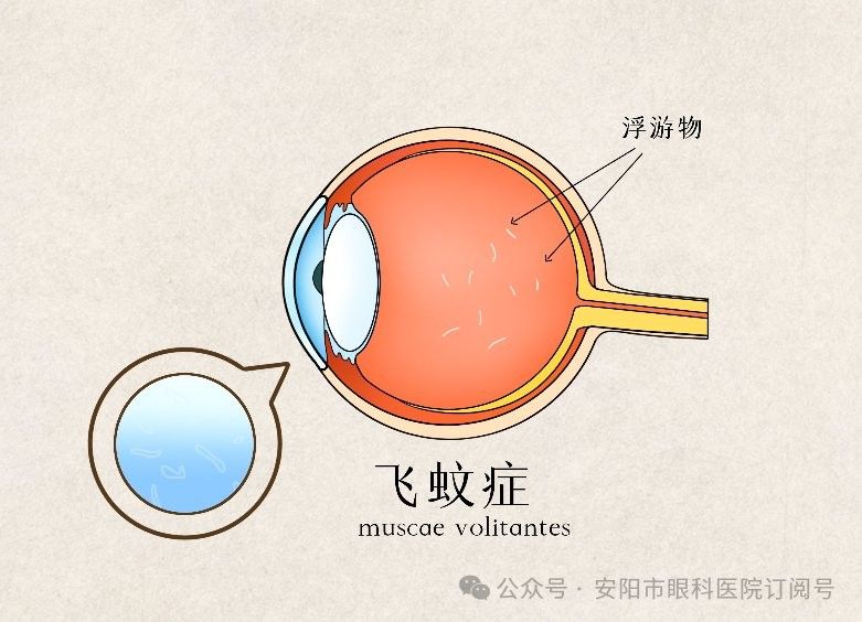 如何區分蒙眼病和白點病：安陽市眼科醫院眼科張磊揭秘飛蚊癥和白點病的區別