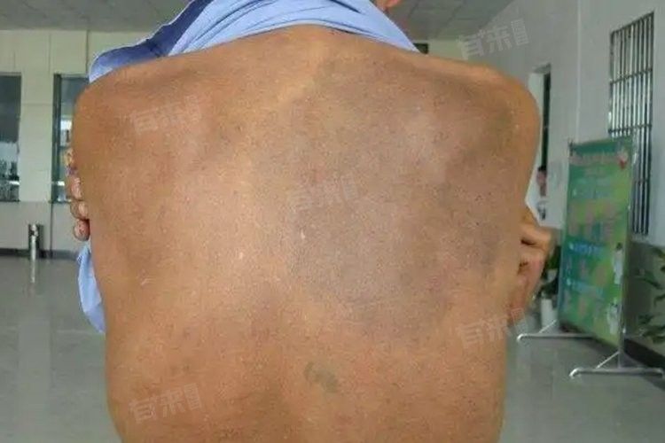 病理性黑斑如何治療？：病理性黑斑怎么治療