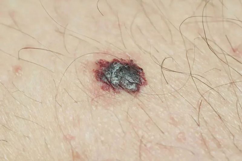 病理性黑斑如何治療？：病理性黑斑怎么治療