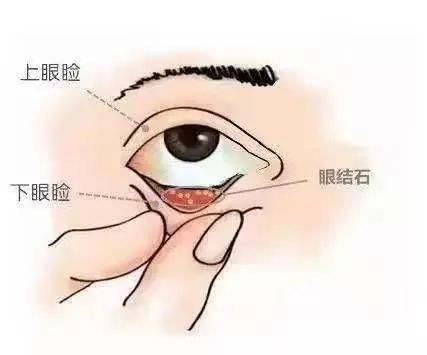 輕微鉆石眼需要用藥嗎：eye科普|眼睛竟然會長“結石” 輕微鉆石眼需要用藥嗎：eye科普|眼睛竟然會長“結石” 龍魚百科 第6張