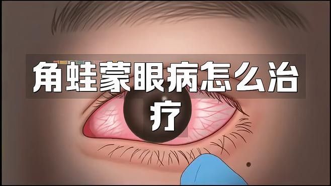 蒙眼病如何治療：蒙眼病應該如何治療